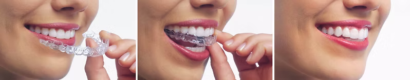 Clear aligners are removable, discreet, and custom-made